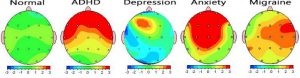 qEEG Brain Scan