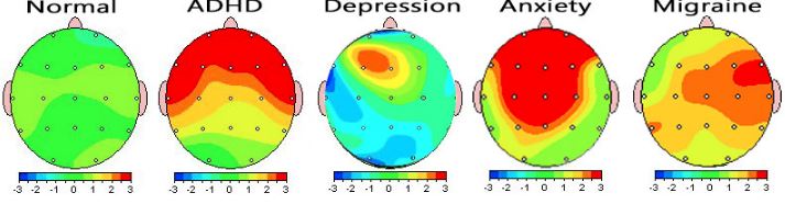 QEEG Brain Mapping Brain Scan 