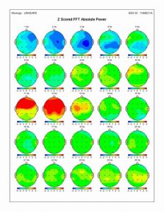 ADHD Brain Map QEEG