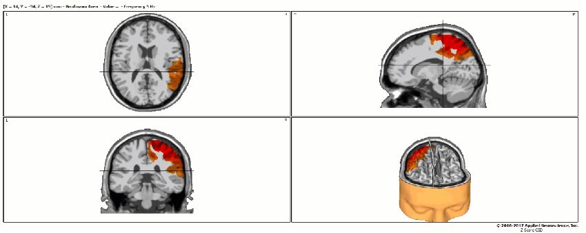 QEEG Brain Mapping Brain Scan